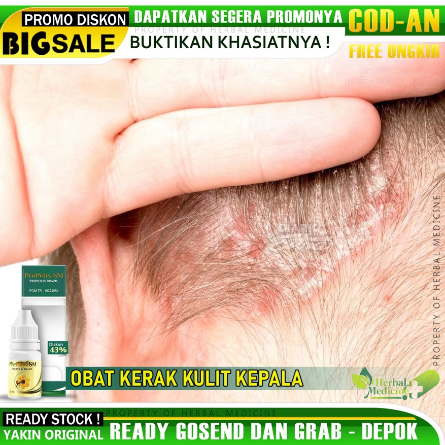 Obat Psoriasis - Kerak Kulit Kepala, Kerak Ketombe, Kepala Gatal-Gatal, Dengan Propolis SM 100% Asli