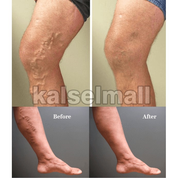 Obat Salep Krim Cream Penghilang Varises Paises Herbal Aman 100% ORIGINAL Maiguankanggao Salap Cina Herbal Tanpa Efek Samping Varicose Veins  Parises Ampuh China Untuk Pengobatan Varises Kaki Tangan Badan Kulit Pegal - Pegal OC4