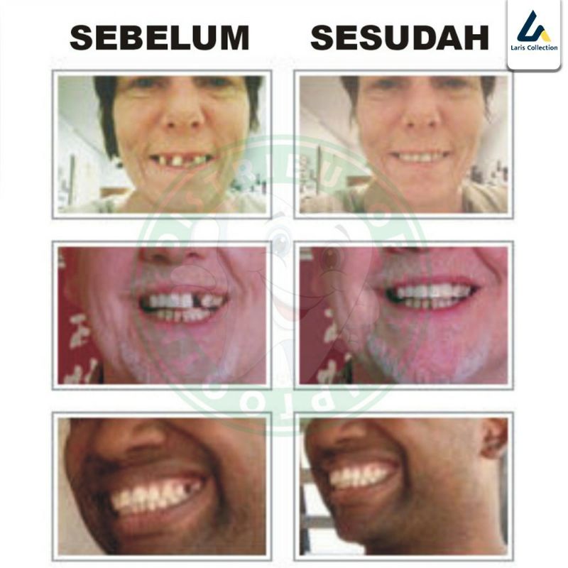 Penambal Gigi Instan/Gigi Palsu/Themthoot