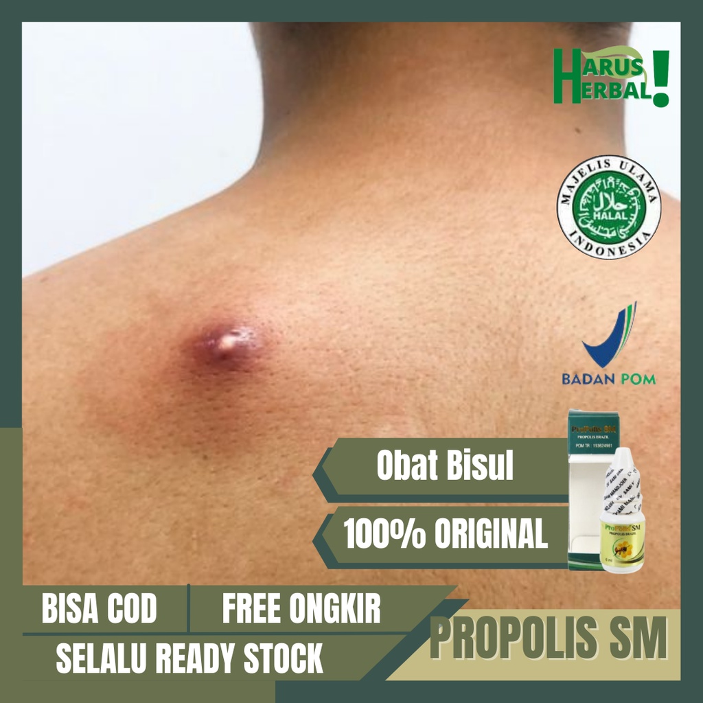 Obat Oles Bisul, Obat Salep Bisul, Obat Bisul Bernanah, Obat Bisul Keras, Obat Penghilang Bisul, Oba