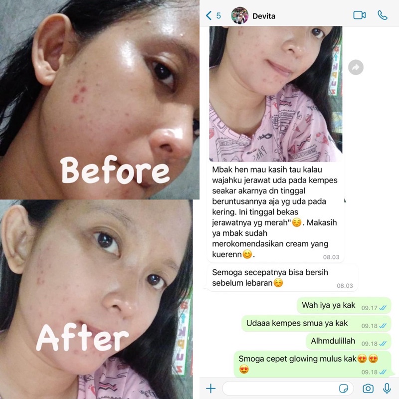 Paket Acne Colista Skin Care BPOM-4