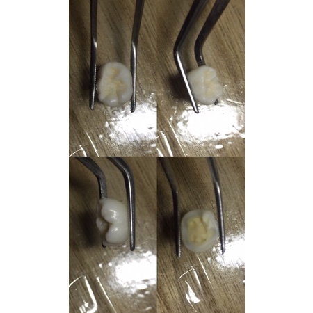 molar gigi susu anak