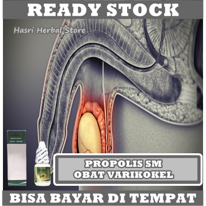 Obat Varikokel Untuk Anak Dan Dewasa Herbal - Obat Buah Zakar Bengkak Sebelah, Obat Urat Testis Bengkak, Obat Kantong Buah Zakar Bengkak, Obat Varises Testis, Obat Hidrokel, Obat Biji Pelir Bengkak Dengan Herbal Propolis SM Asli 100% Original