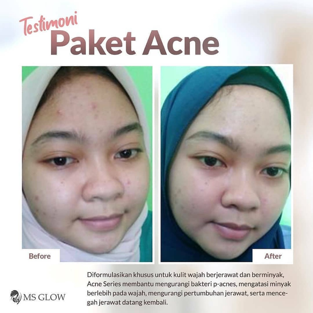 Ms Glow Acne Free Tote Bag Paket Ms Glow Acne Series Ms Glow Original BPOM Skincare Wanita Meredakan Jerawat dan Bruntusan-6