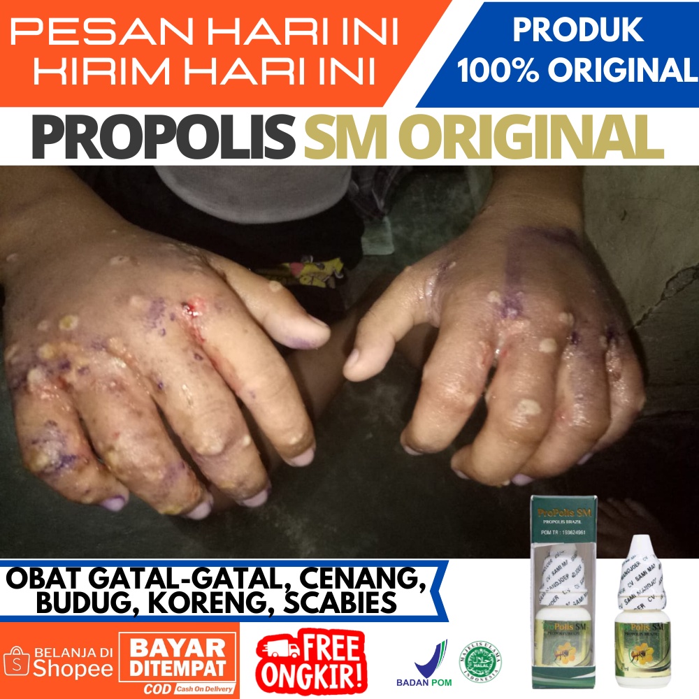 Jual Obat Oles Salep Cenang, Budug, Bisul, Borok, Luka Koreng Basah