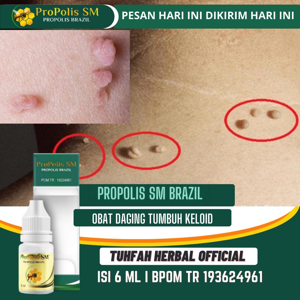 Obat Daging Tumbuh Keloid, Daging Jadi, Penghilang Keloid Bekas Operasi, Obat Keloid Injeksi, Menghi