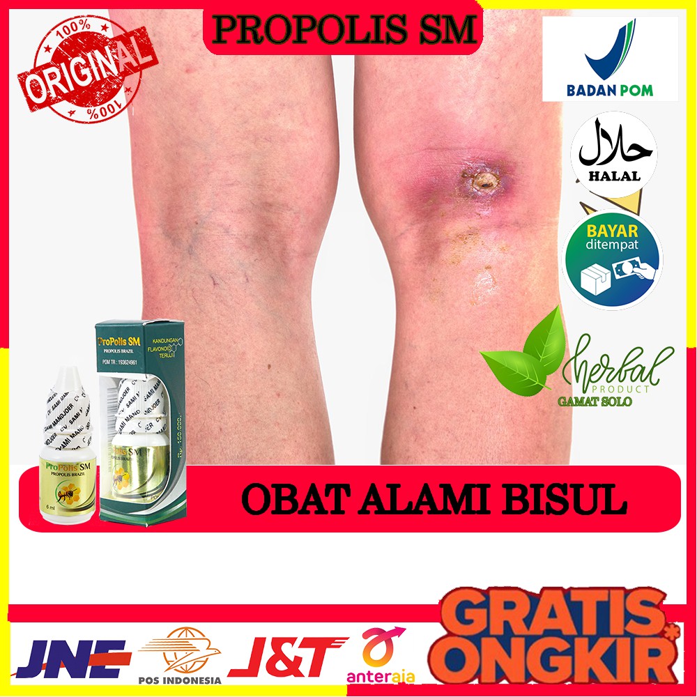 Obat Bisul, Bisul Bernanah, Bisul Menahun, Bisul Kronis, Propolis Sm di Solo - Legal BPOM - HalalMUI