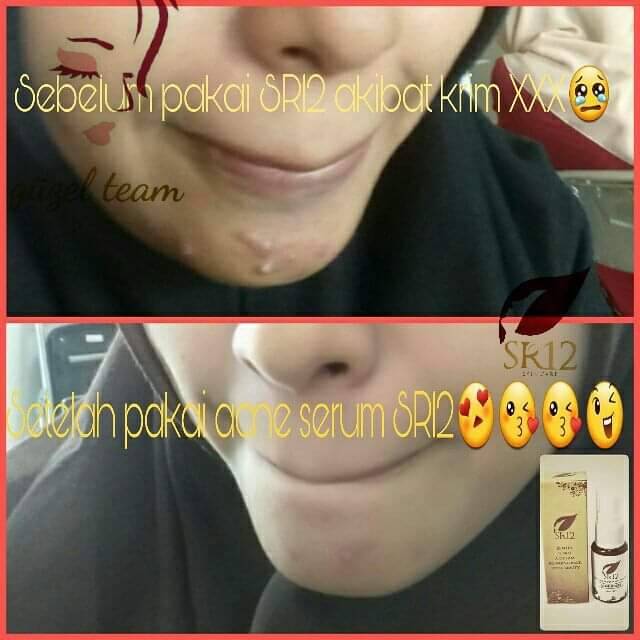 ACNE SERUM SR12 / MENYEMBUHKAN JERAWAT / BERUNTUSAN / MENGHILANGKAN BEKAS JERAWAT