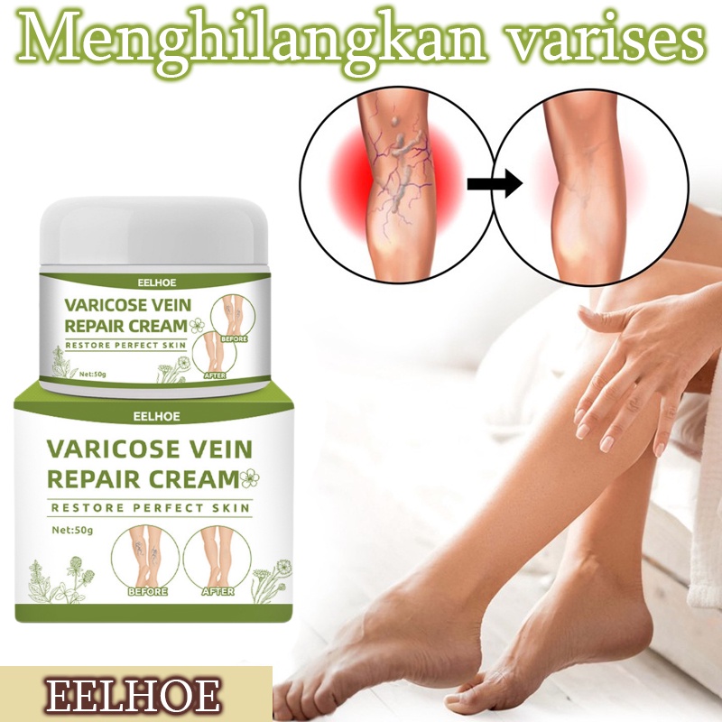 Terlaris !!! Varicose Veins Obat Varises Varikokel Bengkak Benjolan Buah Zakar Nyeri Testis Paling Ampuh Varicose Veins Treatment Cream/Obat Krim Varises Parises Tanpa Operasi