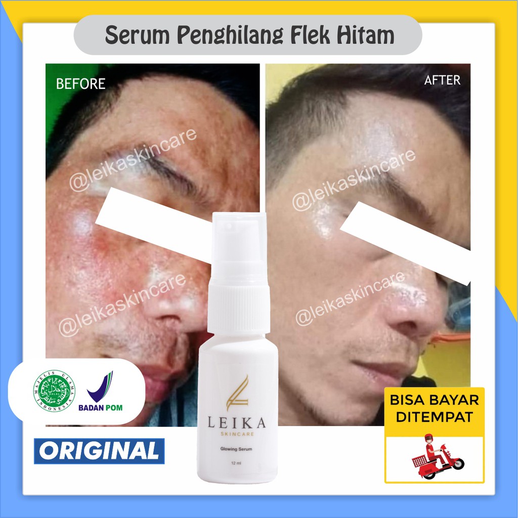 Serum Penghilang Flek Hitam di Wajah Ampuh BPOM Menghilangkan Flek Hitam Membandel Menahun Permanen 