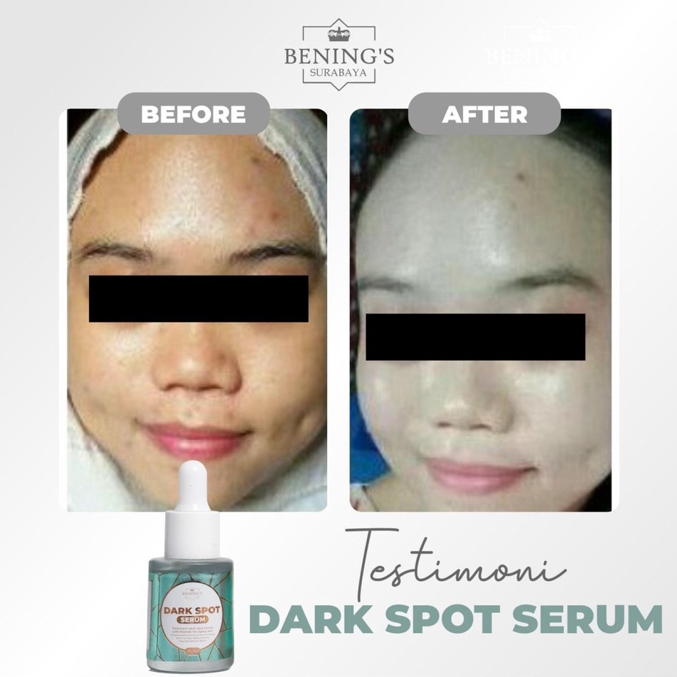 SERUM DARK SPOT BENING SKINCARE DR OKY PRATAMA  MENGATASI FLEK MELASMA MENCERAHKAN