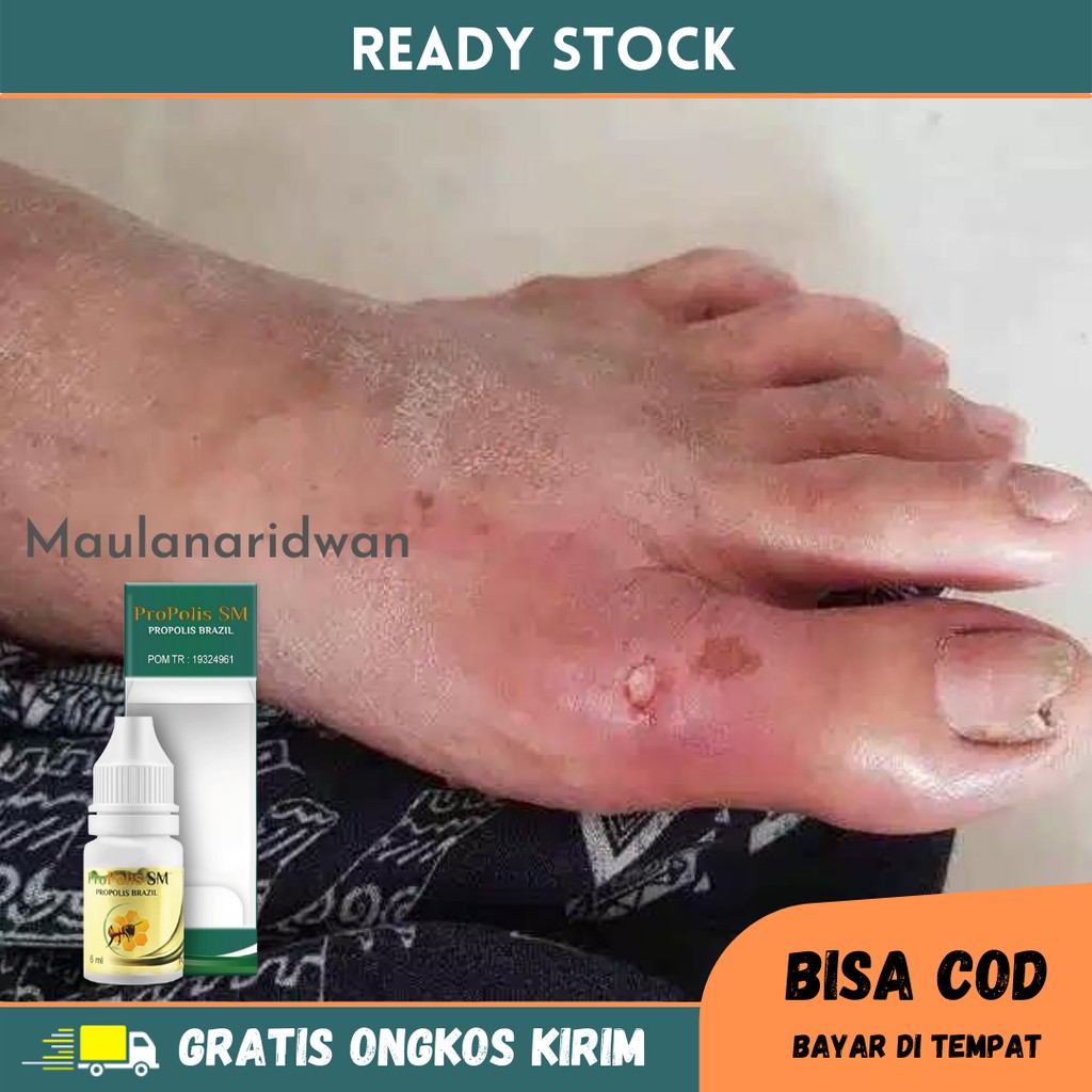 Obat Luka Borok Bernanah, Luka Bengkak Dan Berair, Infeksi Pada Luka, Luka Gatal, Luka Lepuh, Obat O