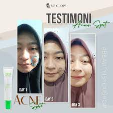 Ms Glow Acne Spot Ms Glow Original 100% Spot Totol Jerawat Terampuh Ms Glow