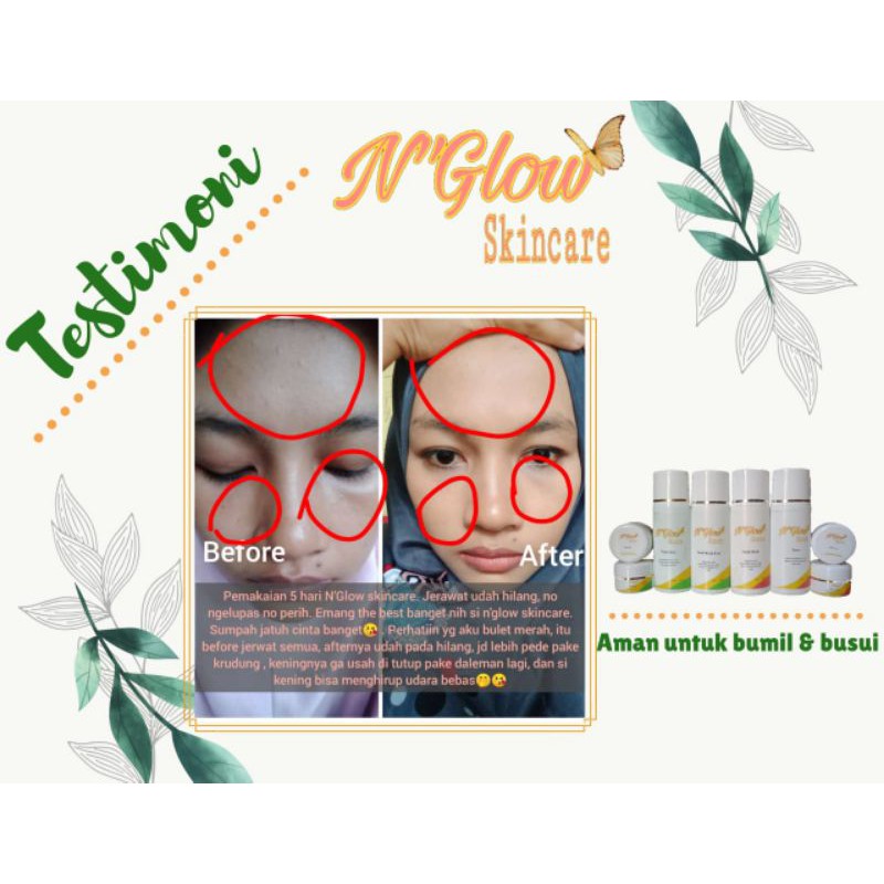 N Glow Skincare Paket Normal Atau Paket Acne 100 Original Shopee Indonesia