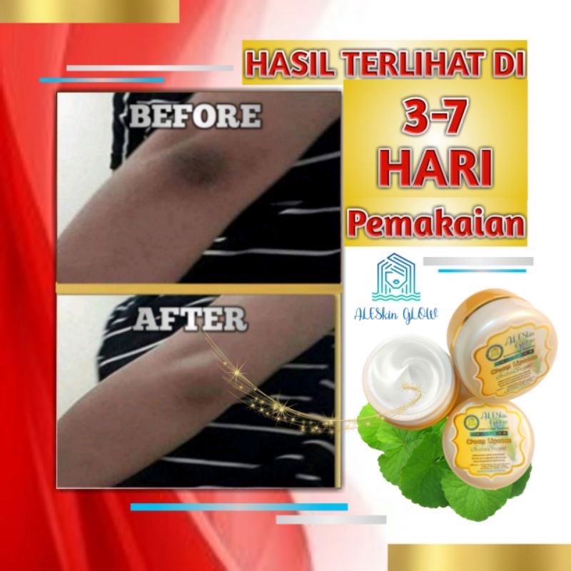 MALAYEKA CREAM PEMUTIH KETIAK Cream Pencerah Lipatan Bokong Leher dan Selangkangan