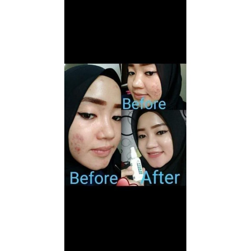 Natura beauty spray, pembersih luka diabetes, serum jerawat, obat cacar
