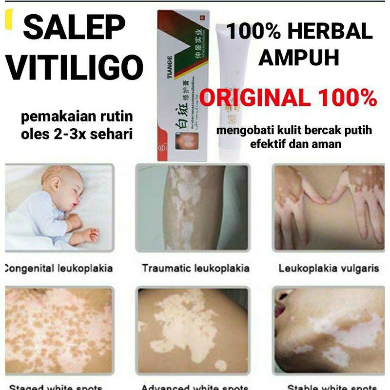 SALEP VITILIGO ORIGINAL 100% Tiange cream psolaren solaren import