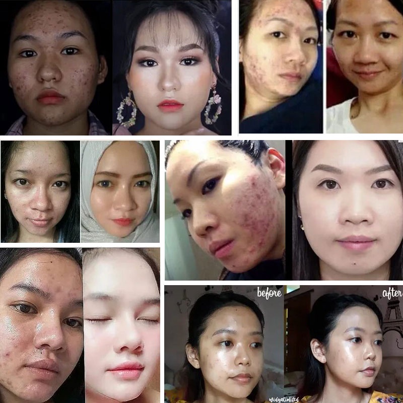 Cream Obat Jerawat Paling Ampuh ​Acne Rejuvenation Cream Jerawat Krim Jerawat Menghilangkan Jerawat Cepat Menghilangkan Jerawat Removal of Acne Cream Untuk Memperbaiki Kulit Denga Krim Penghilang Jerawat dan Bekas Jerawat Pria dan Wanita 30g