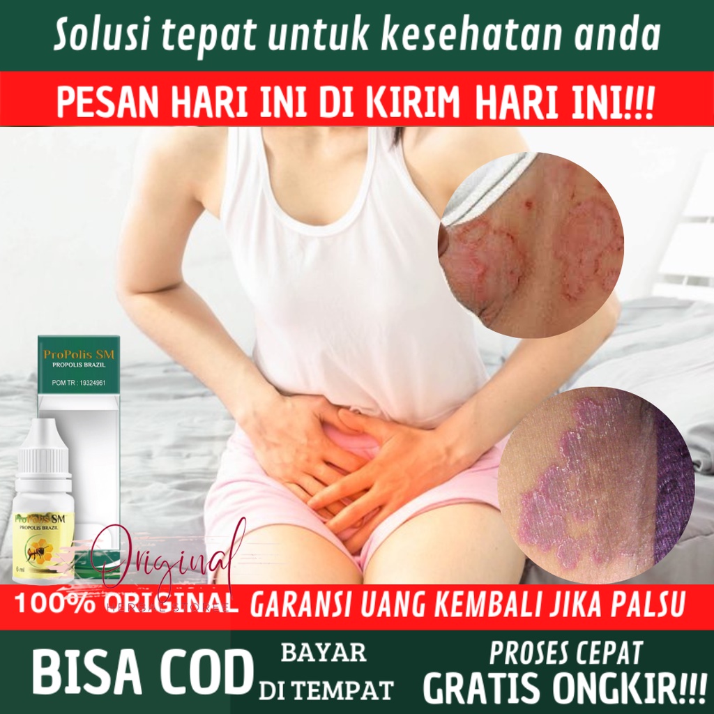 Obat Selangkangan Iritasi, Sakit, Perih, Obat Kurap Selangkangan,Obat Selangkangan Lecet, Obat Irita