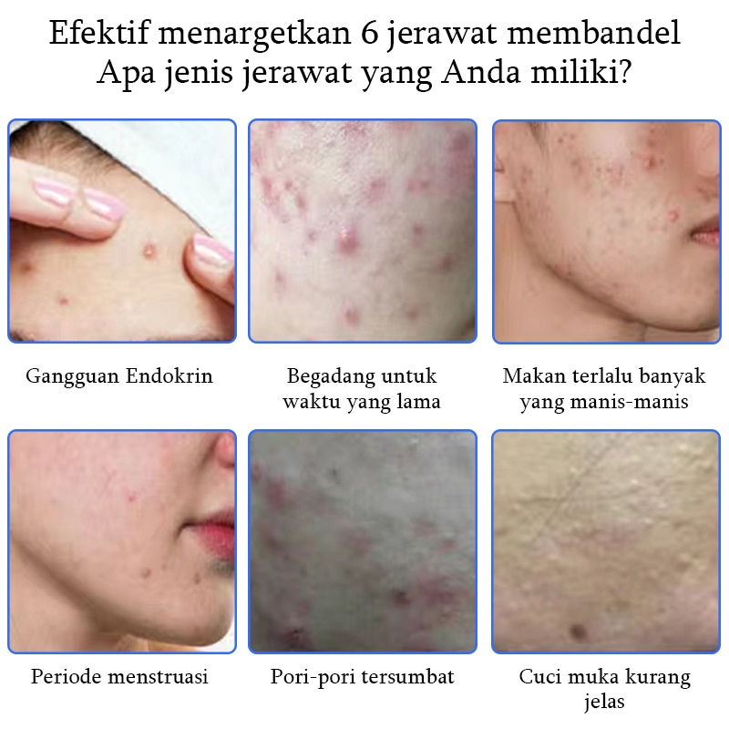 Serum Cream penghilang jerawat Gel Perawatan jerawat Cream untuk jerawat 30g Memperbaiki Menenangkan dan memperbaiki jerawat Kulit berjerawat Kulit halus Lembut dan tembus pandang