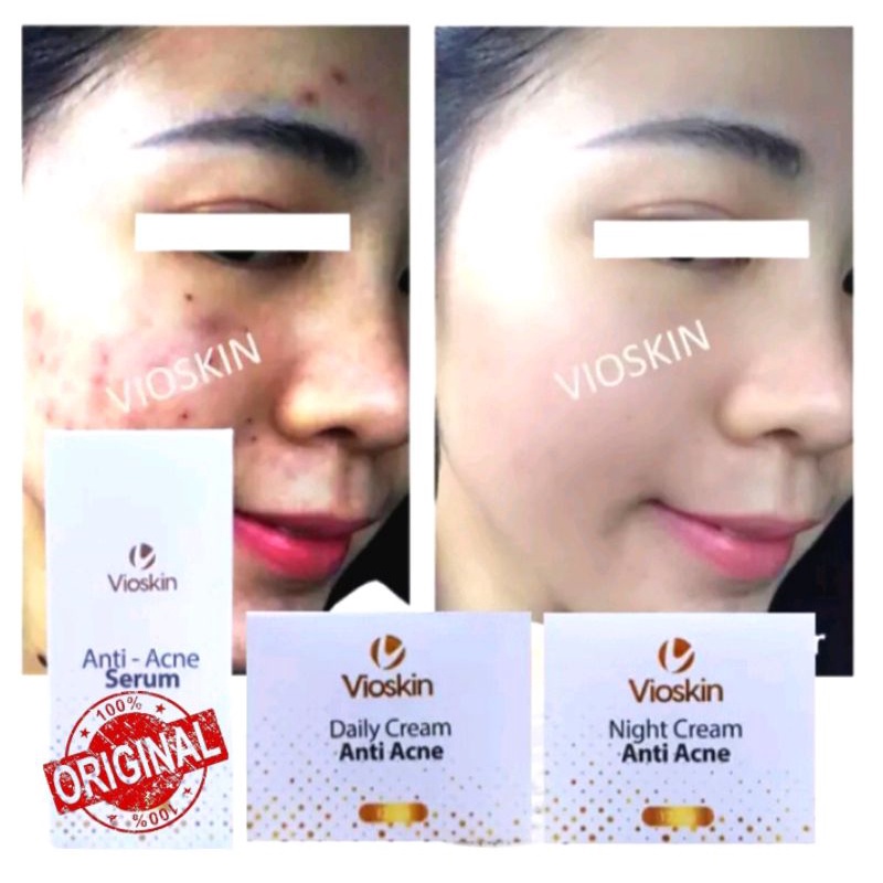 VIOSKIN Anti Acne Serum VIOSKIN Cream Obat Penghilang Jerawat Paling Ampuh Pria Wanita Penghilang Be