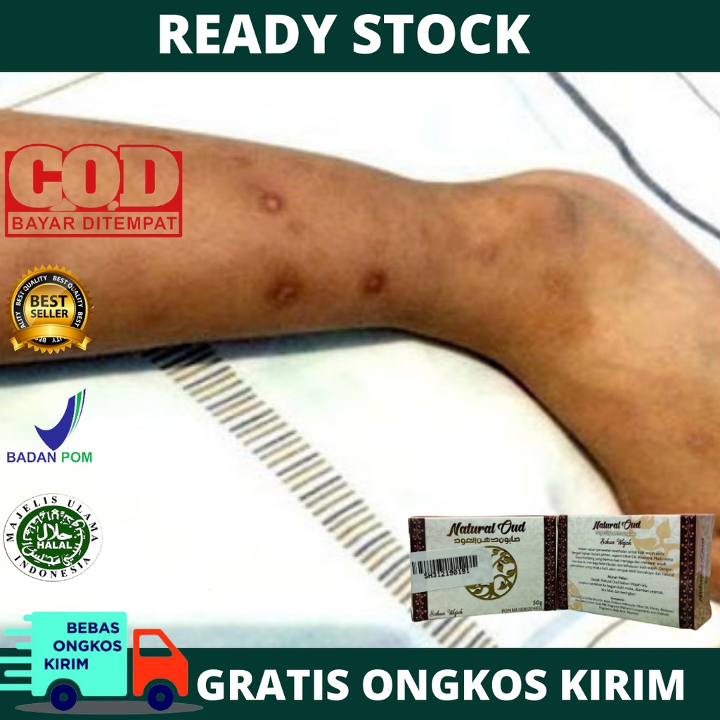 Sabun Penghilang Bekas Luka Koreng Hitam di Kaki, Sabun Pembersih Bekas Koreng di Kaki, Penghilang B