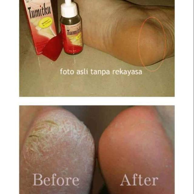 Bisa COD - tumitku obat kaki pecah original 30ml BPOM Solusi Kaki Pecah kapalan bisa cod