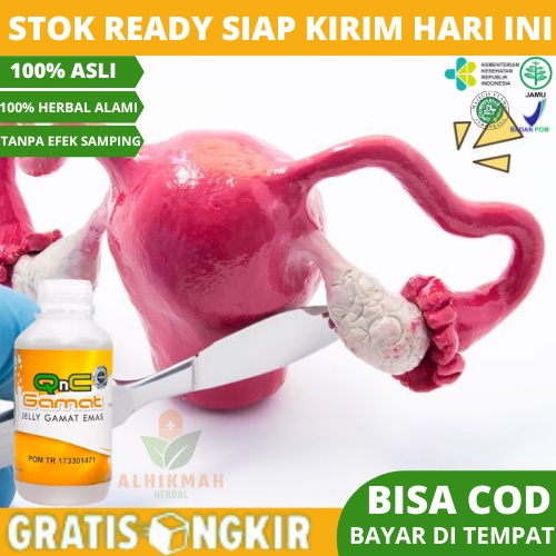 Obat Kista Ovarium, Obat Kista di Rahim, Obat Kista, Obat Kista Endometriosis, Miom, Obat Penghilang