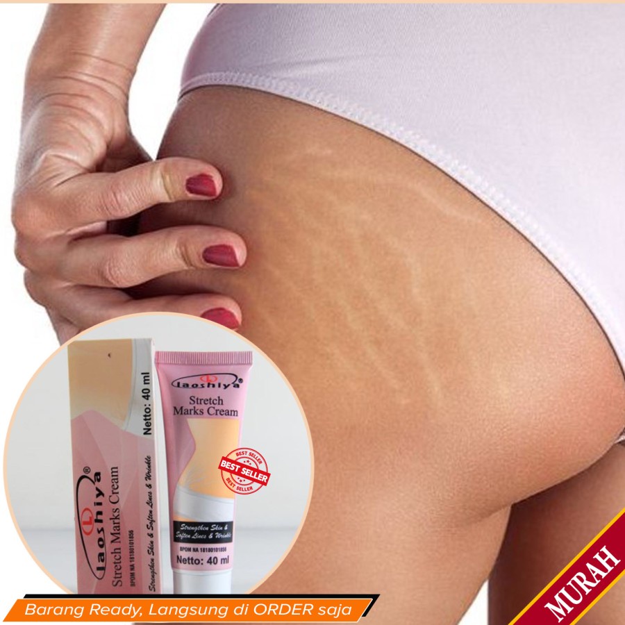 Obat Strechmark Paling Ampuh Laoshiya Cream Stretchmarks Cream Penghilang Strechmark Ampuh Permanen Bpom