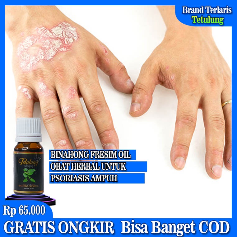 Fresim Oil, Obat Psoriasis, Obat Psoriasis Kulit Kepala, Obat Psoriasis Kulit, Obat Psoriasis Kulit 