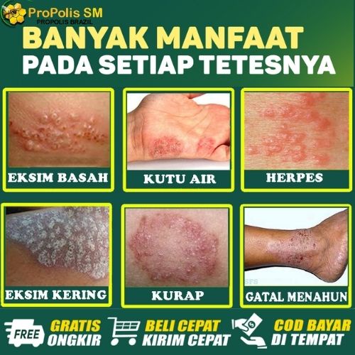 Obat Eksim, Gatal Eksim, Eksim Kering dan Basah, Obat Dermatitis Seboroik - Propolis SM