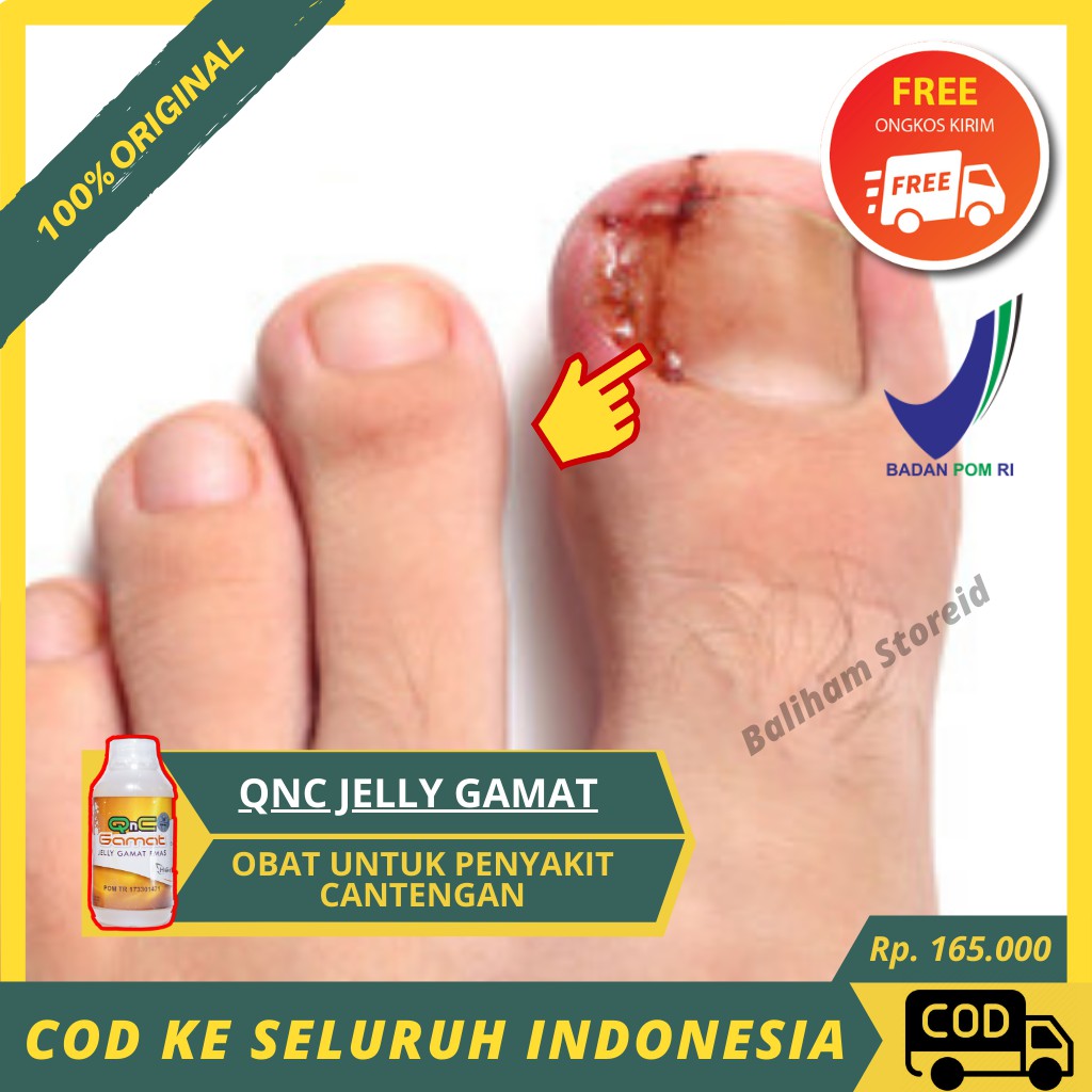 Obat Cantengan Paronikia Infeksi Kulit Kaki Bengkak Herbal Original 100 Alami Qnc Jelly Gamat Shopee Indonesia