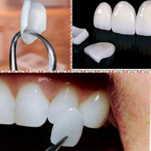 ⅍ Teeth Veneer, Gigi Aplikasi, Gigi Kelinci. Vener ♠