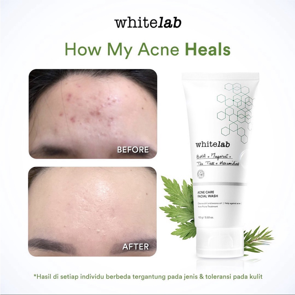 Whitelab Acne Care Facial Wash NEW