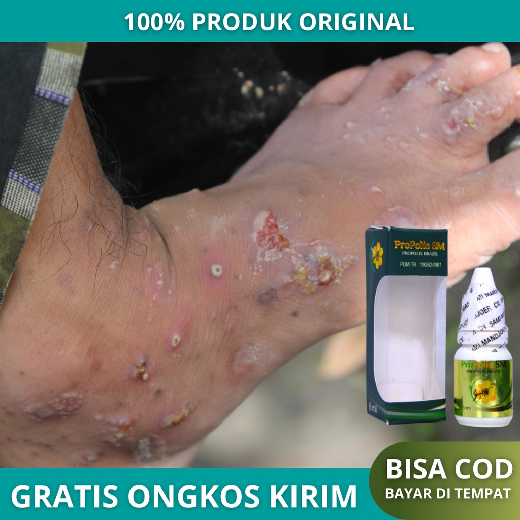 Obat Budug / Borok di Kaki, Obat Penghilang Bekas Budug Borok Bernanah Basah - Propolis SM