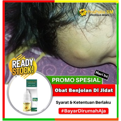 Obat Benjolan Di Jidat, Penghilang Benjolan di jidat, Untuk Menghilangkan Benjolan di Jidat, Alami B