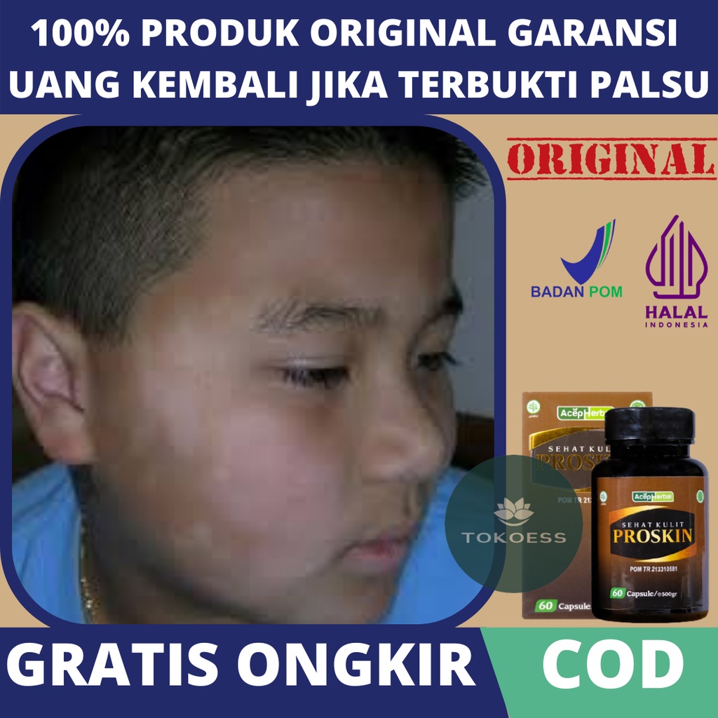Obat Penghilang Balas Bogo, Obat Penghilang Hapur Besi, Obat Penghilang Bercak Putih di Wajah, Obat 