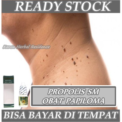 Obat Perontok Kutil - Penghilang Kutil - Pengempis Daging Jadi - Obat Kutil di Kelopak Mata - Kutil di Leher - Kutil di Wajah / Tubuh - Pemnghilang Papiloma - Obat Herbal Propolis Brazil SM, Propolis SM 100% Original