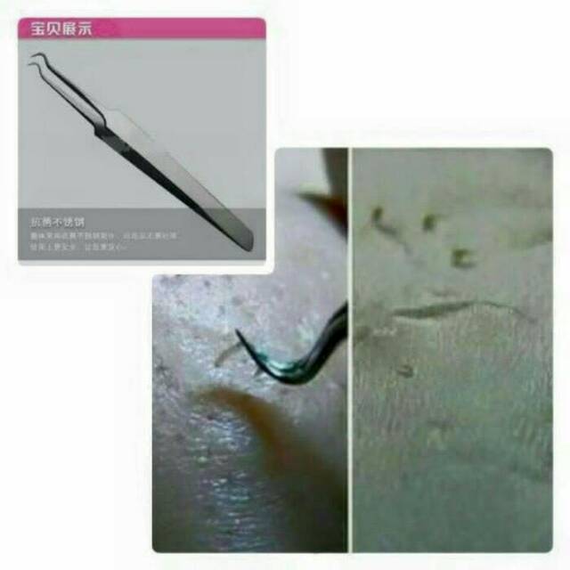 pinset komedo - alat pembersih komedo - blackhead remover