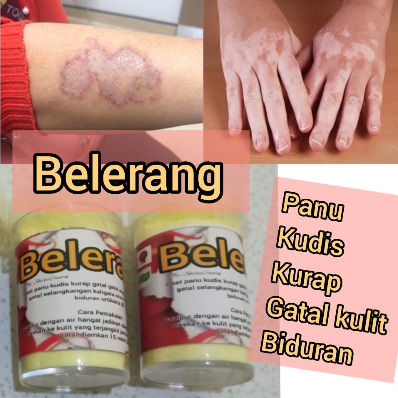 BELERANG OBAT PANU KUDIS KURAP GATAL KULIT 30 gram