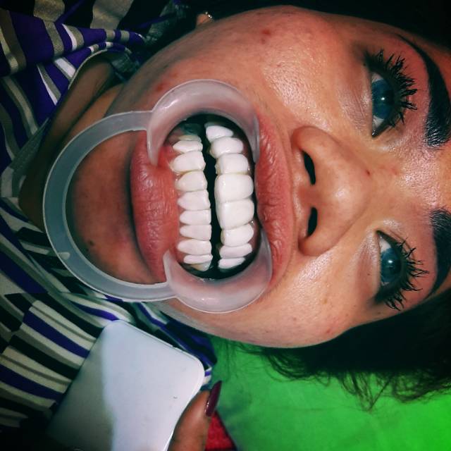 Venner gigi, merapikan gigi dan memutihkan gigi @eyelash.angelia