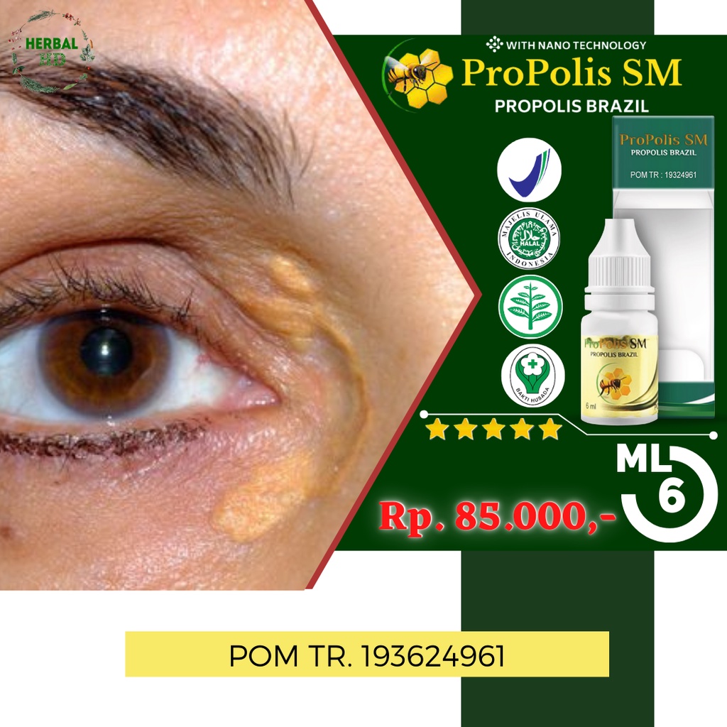 Jual Obat Xanthelasma / Gumpalan Lemak Di Kelopak Mata, Obat Penghilang ...