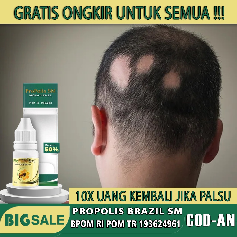 Obat Herbal Penyakit Alopecia Areata - obat penumbuh rambut botak akibat alopecia areata - obat oles