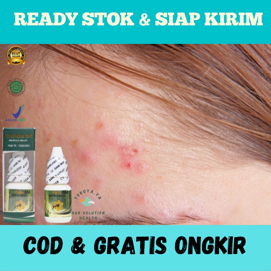 PROPOLIS SM 100% ORIGINAL BPOM, Obat Herbal Pembersih Bruntusan di Jidat, Obat Herbal Penghilang Ber