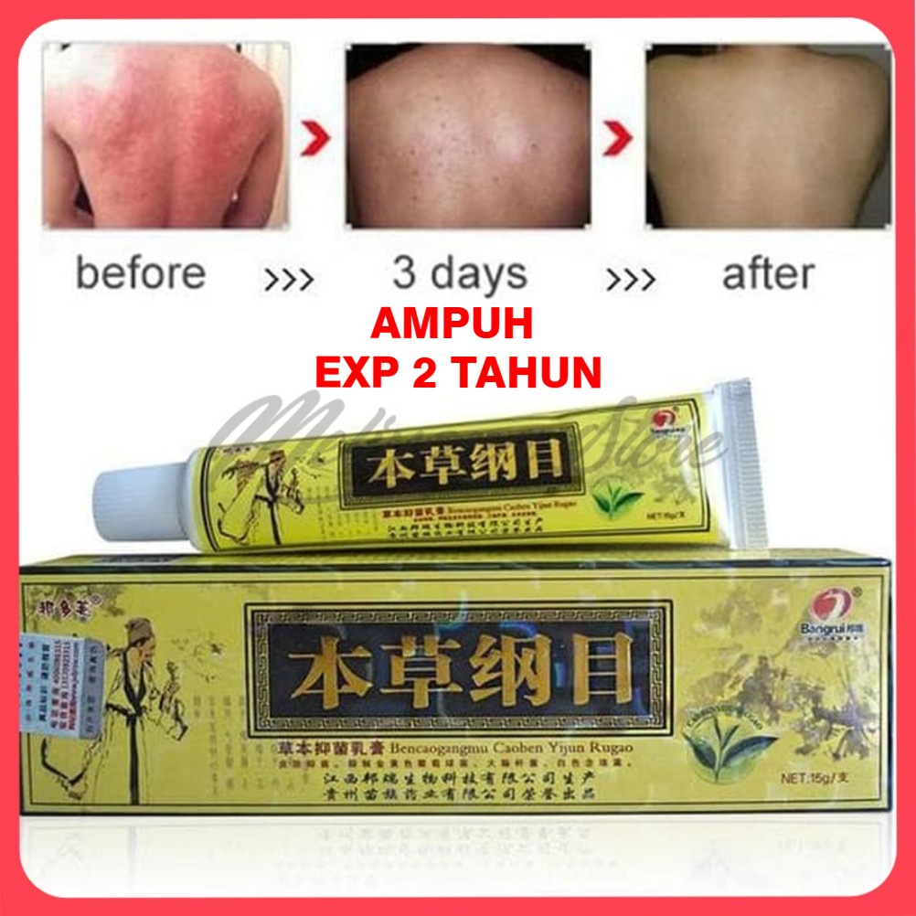 Import Original Salep Herbal Untuk Psoriasis Dermatitis Dan Eczem