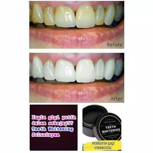 Pemutih gigi/odol khusus behel/pemutih gigi kuning/penghilang kuning gigi/pembersih gigi