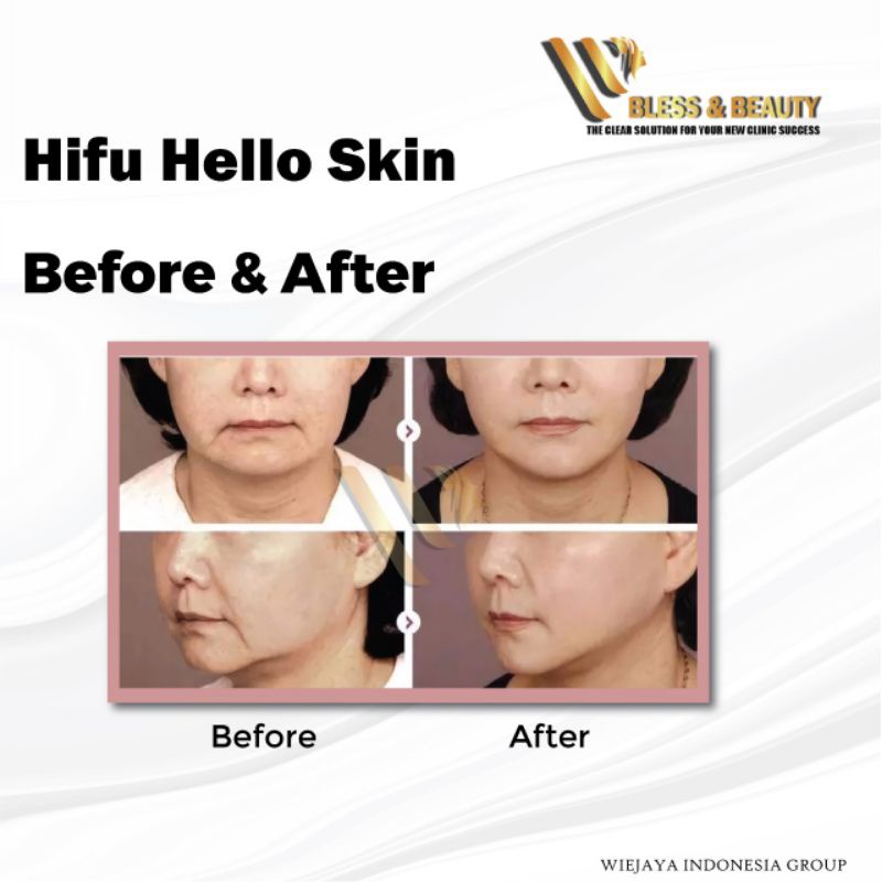 Alat Perawatan Wajah Hifu Hello Skin Mengencangkan  Kulit V Shape Original