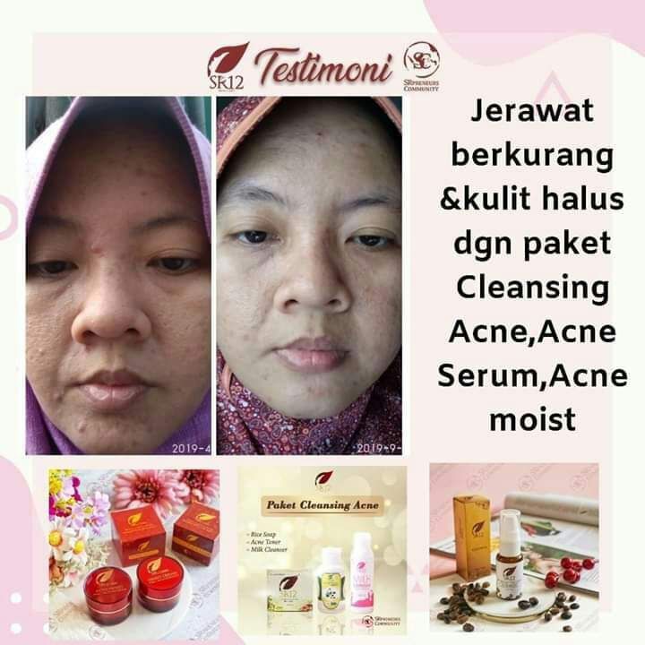 ACNE SERUM SR12 | OBAT PENGHILANG JERAWAT | SERUM RADANG JERAWAT