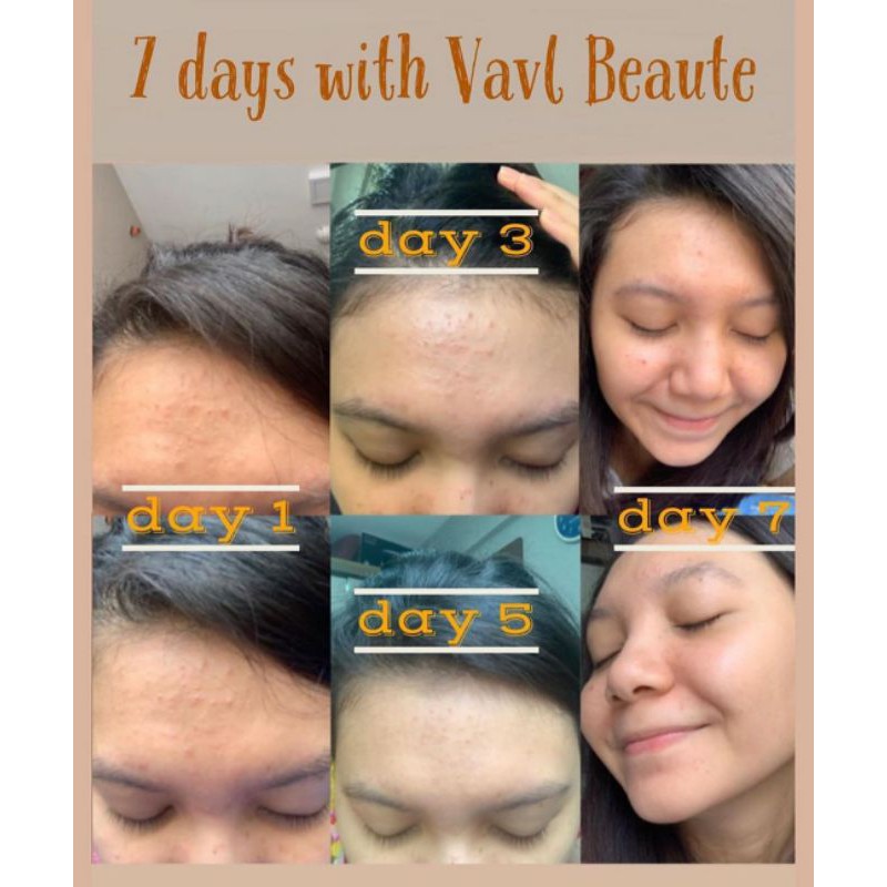 VAVL PAKET BYE ACNE  Free pouch &amp; gift