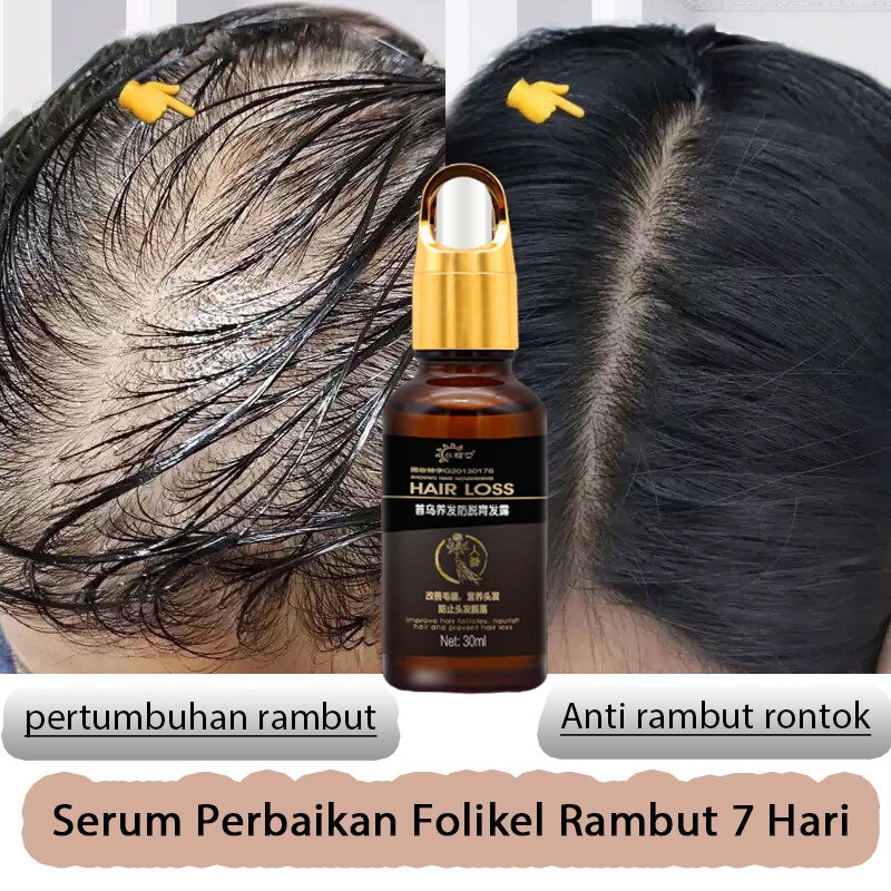 hair tonik 30ml penumbuh rambut/penumbuh rambut botak/serum penumbuh rambut/Memperbaiki folikel rambut/merangsang pertumbuhan rambut/perawatan rambut